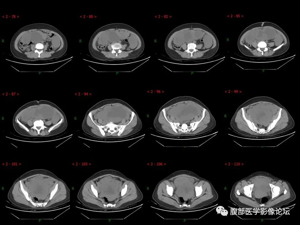 影像PPT - 【病例】盆腔混合型性索间质肿瘤1例CT及MR-7 影像PPT - 【病例】盆腔混合型性索间质肿瘤1例CT及MR-7