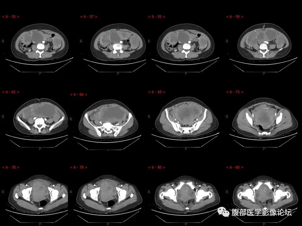 影像PPT - 【病例】盆腔混合型性索间质肿瘤1例CT及MR-8 影像PPT - 【病例】盆腔混合型性索间质肿瘤1例CT及MR-8
