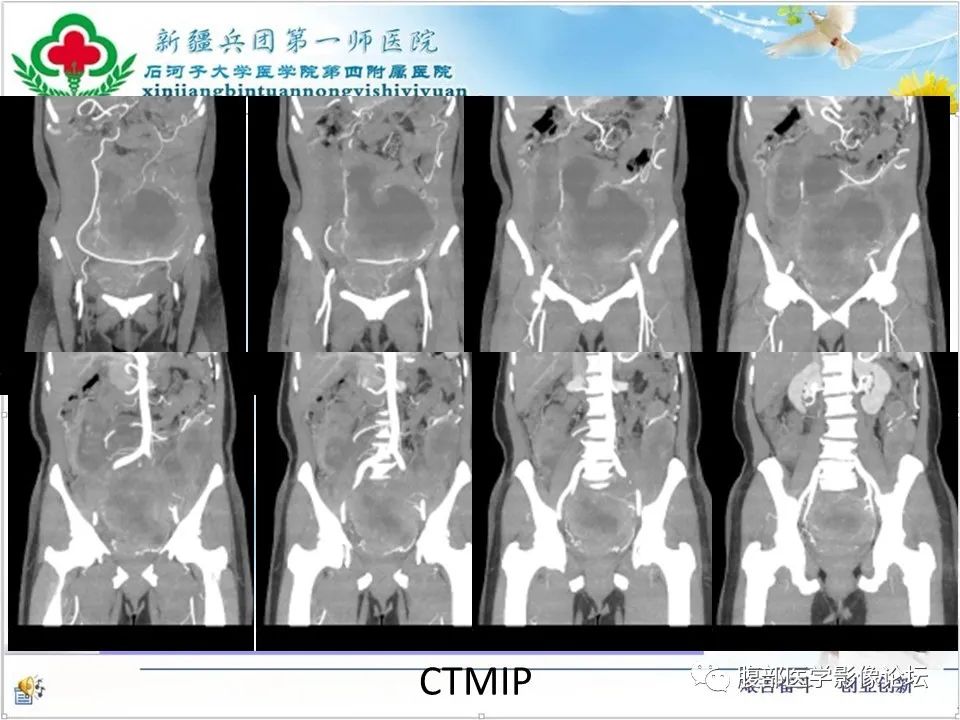 影像PPT - 【病例】盆腔混合型性索间质肿瘤1例CT及MR-10 影像PPT - 【病例】盆腔混合型性索间质肿瘤1例CT及MR-10