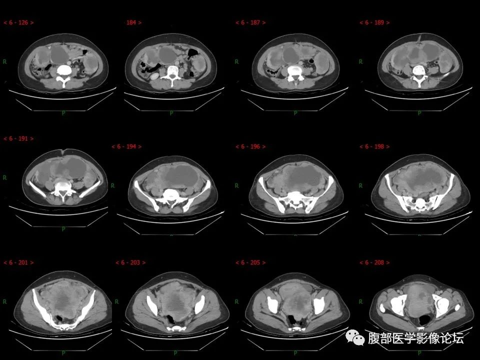 影像PPT - 【病例】盆腔混合型性索间质肿瘤1例CT及MR-9 影像PPT - 【病例】盆腔混合型性索间质肿瘤1例CT及MR-9