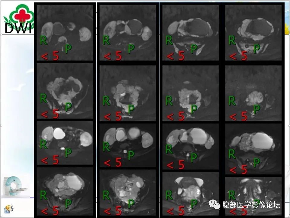 影像PPT - 【病例】盆腔混合型性索间质肿瘤1例CT及MR-14 影像PPT - 【病例】盆腔混合型性索间质肿瘤1例CT及MR-14