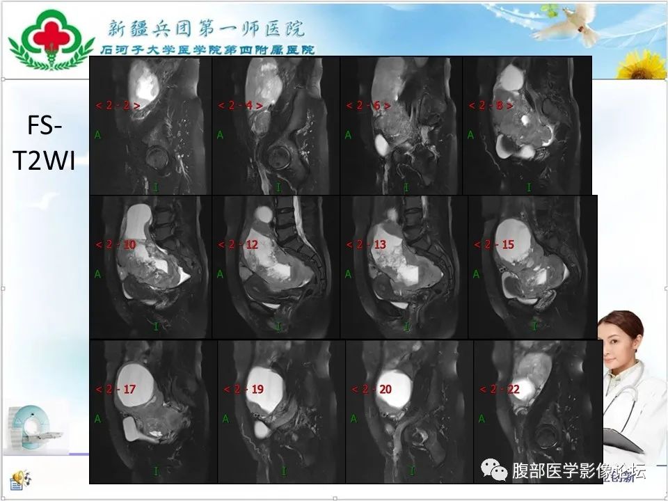 影像PPT - 【病例】盆腔混合型性索间质肿瘤1例CT及MR-11 影像PPT - 【病例】盆腔混合型性索间质肿瘤1例CT及MR-11