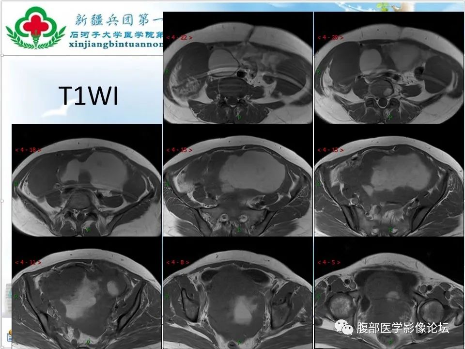 影像PPT - 【病例】盆腔混合型性索间质肿瘤1例CT及MR-12 影像PPT - 【病例】盆腔混合型性索间质肿瘤1例CT及MR-12