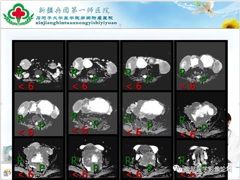 影像PPT - 【病例】盆腔混合型性索间质肿瘤1例CT及MR-15 影像PPT - 【病例】盆腔混合型性索间质肿瘤1例CT及MR-15