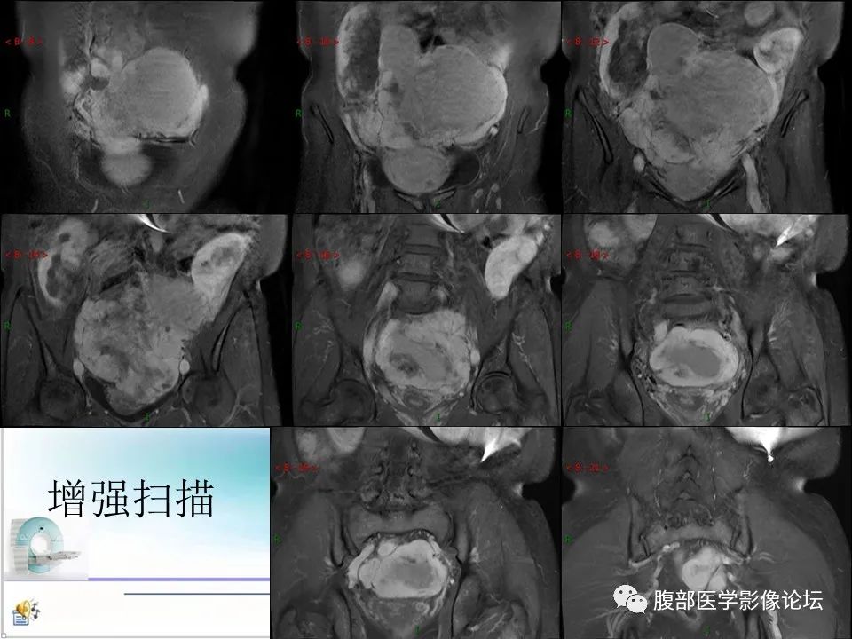 影像PPT - 【病例】盆腔混合型性索间质肿瘤1例CT及MR-17 影像PPT - 【病例】盆腔混合型性索间质肿瘤1例CT及MR-17
