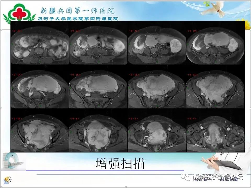 影像PPT - 【病例】盆腔混合型性索间质肿瘤1例CT及MR-18 影像PPT - 【病例】盆腔混合型性索间质肿瘤1例CT及MR-18
