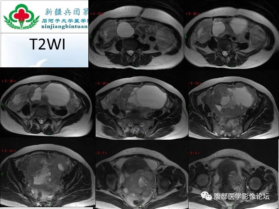 影像PPT - 【病例】盆腔混合型性索间质肿瘤1例CT及MR-1 影像PPT - 【病例】盆腔混合型性索间质肿瘤1例CT及MR-1