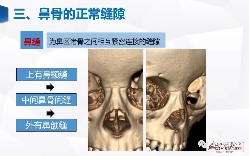 影像PPT - 【PPT】鼻骨正常CT解剖、变异与骨折-6