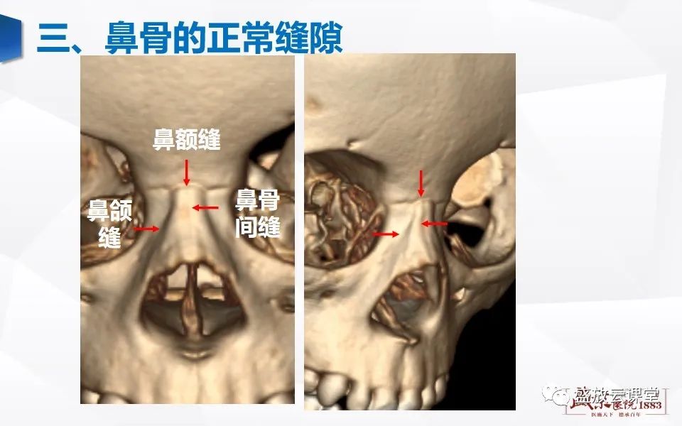 影像PPT - 【PPT】鼻骨正常CT解剖、变异与骨折-7