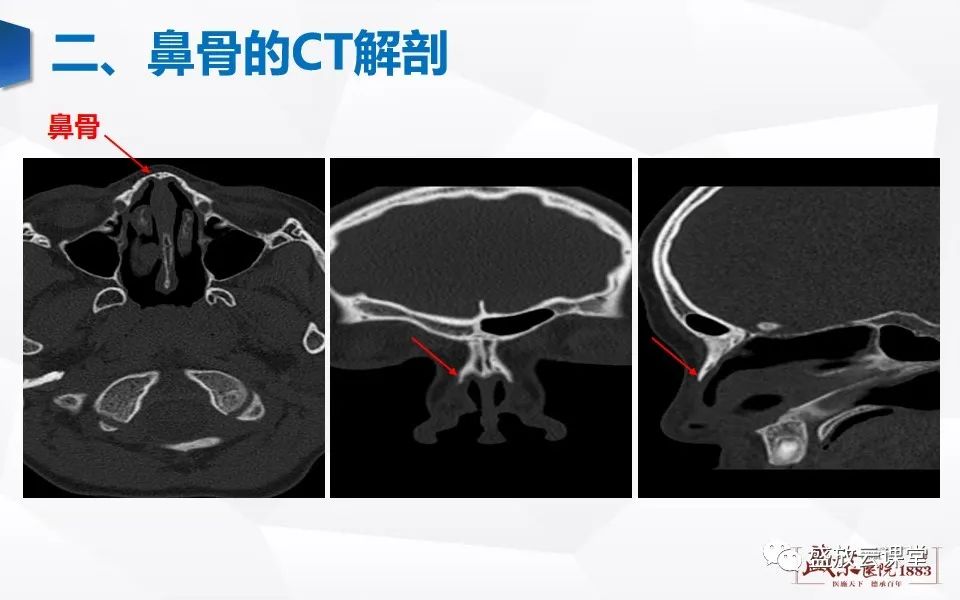 影像PPT - 【PPT】鼻骨正常CT解剖、变异与骨折-5