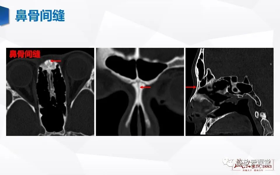 影像PPT - 【PPT】鼻骨正常CT解剖、变异与骨折-13