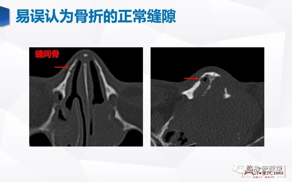 影像PPT - 【PPT】鼻骨正常CT解剖、变异与骨折-17