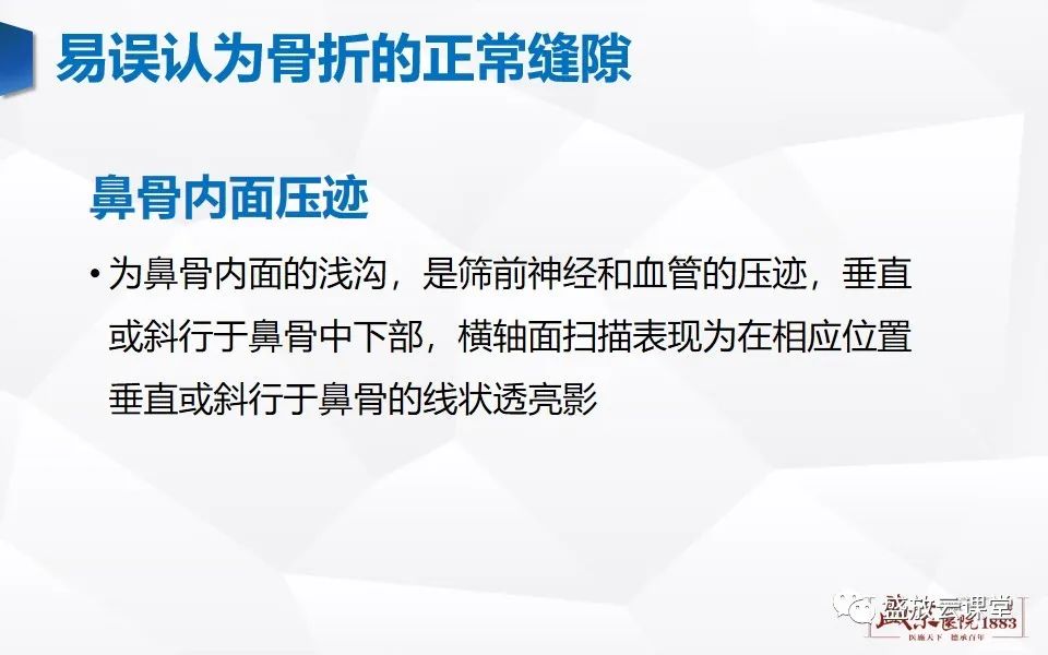 影像PPT - 【PPT】鼻骨正常CT解剖、变异与骨折-21