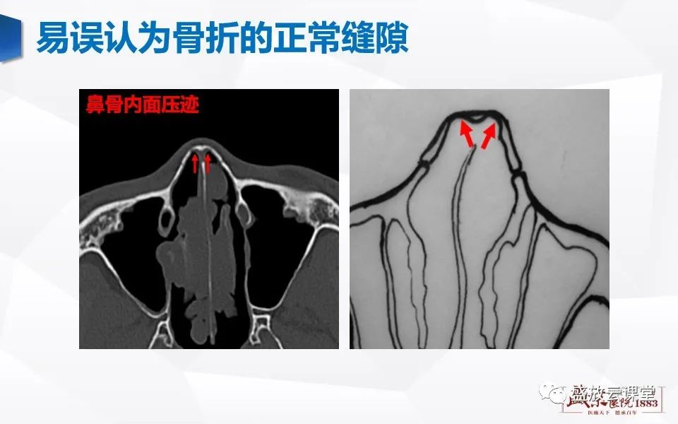 影像PPT - 【PPT】鼻骨正常CT解剖、变异与骨折-22