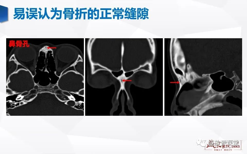 影像PPT - 【PPT】鼻骨正常CT解剖、变异与骨折-19
