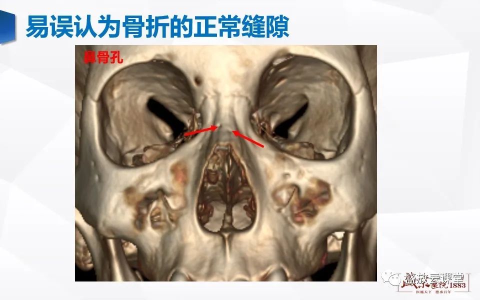 影像PPT - 【PPT】鼻骨正常CT解剖、变异与骨折-20