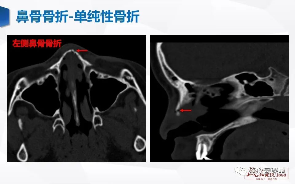 影像PPT - 【PPT】鼻骨正常CT解剖、变异与骨折-26
