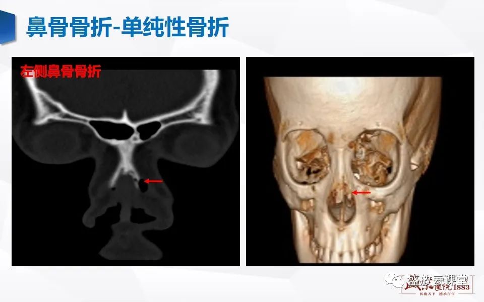 影像PPT - 【PPT】鼻骨正常CT解剖、变异与骨折-27