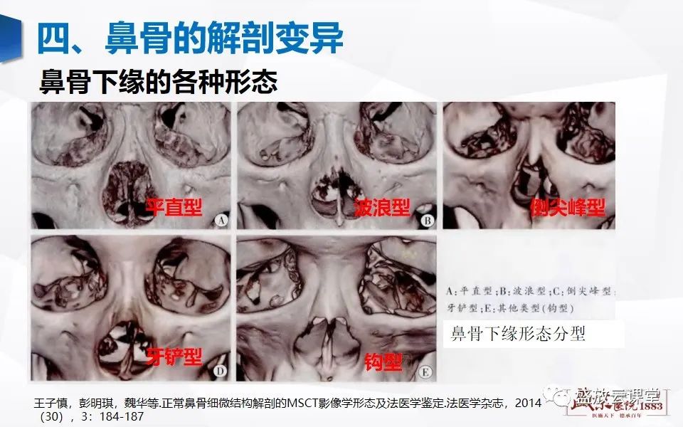 影像PPT - 【PPT】鼻骨正常CT解剖、变异与骨折-23