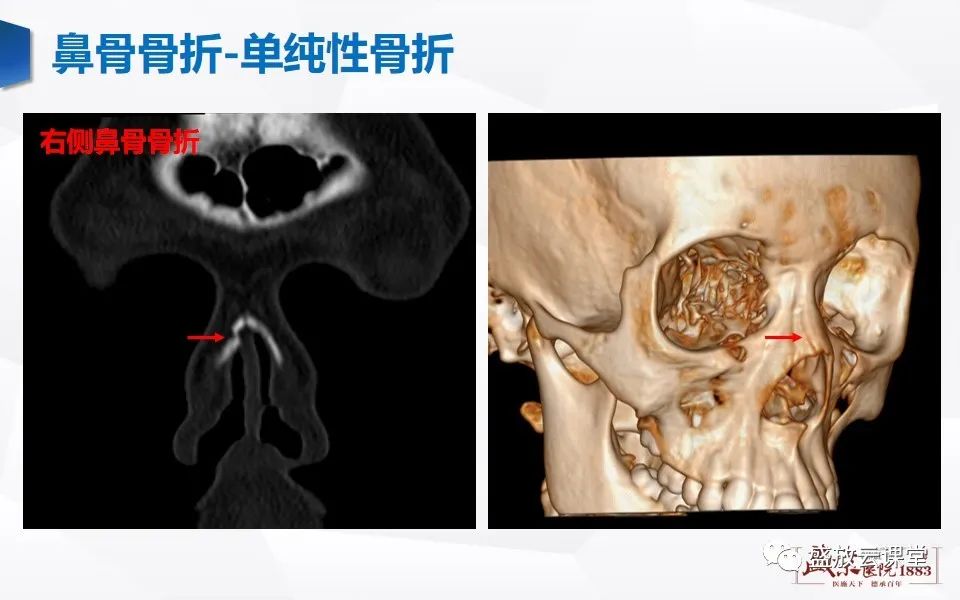 影像PPT - 【PPT】鼻骨正常CT解剖、变异与骨折-29