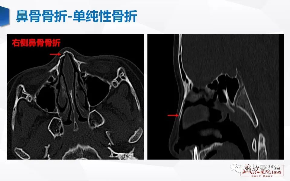 影像PPT - 【PPT】鼻骨正常CT解剖、变异与骨折-28