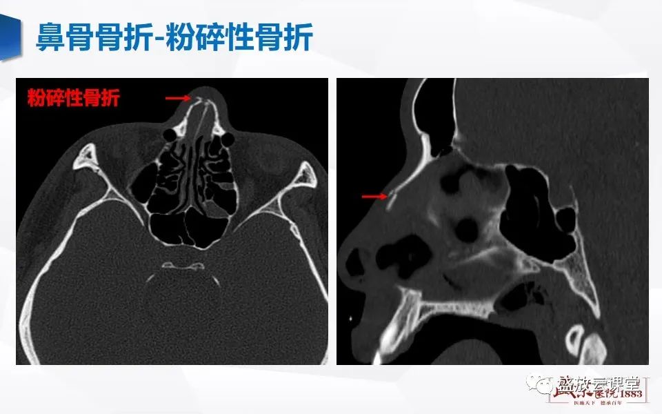 影像PPT - 【PPT】鼻骨正常CT解剖、变异与骨折-30