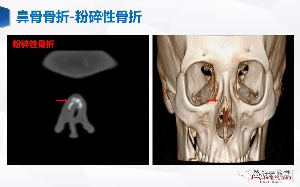 影像PPT - 【PPT】鼻骨正常CT解剖、变异与骨折-33