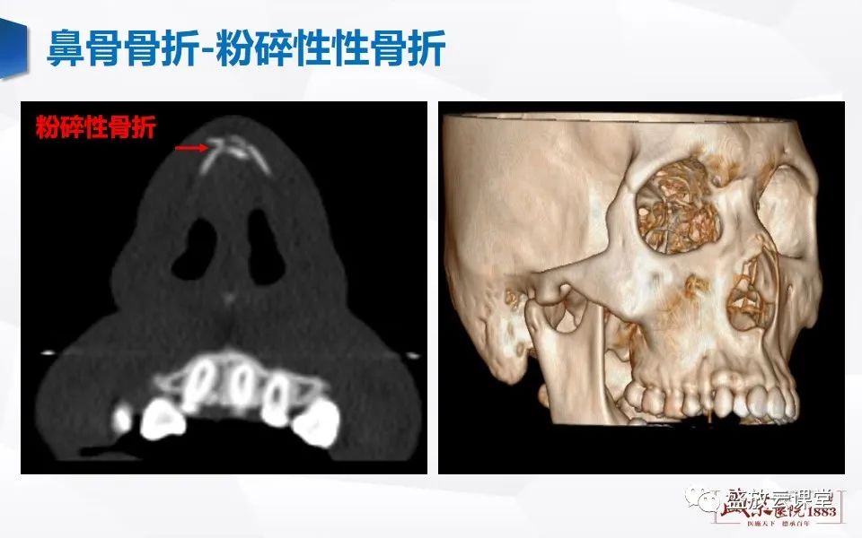 影像PPT - 【PPT】鼻骨正常CT解剖、变异与骨折-31