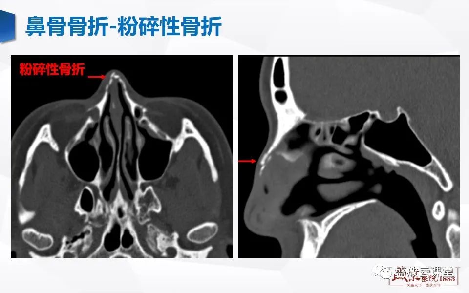 影像PPT - 【PPT】鼻骨正常CT解剖、变异与骨折-32