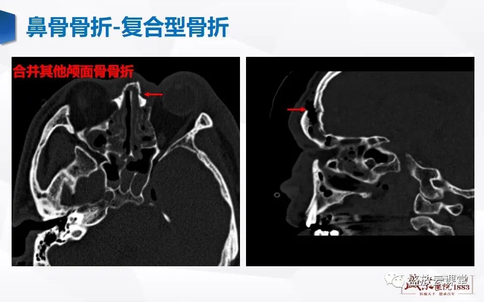 影像PPT - 【PPT】鼻骨正常CT解剖、变异与骨折-36