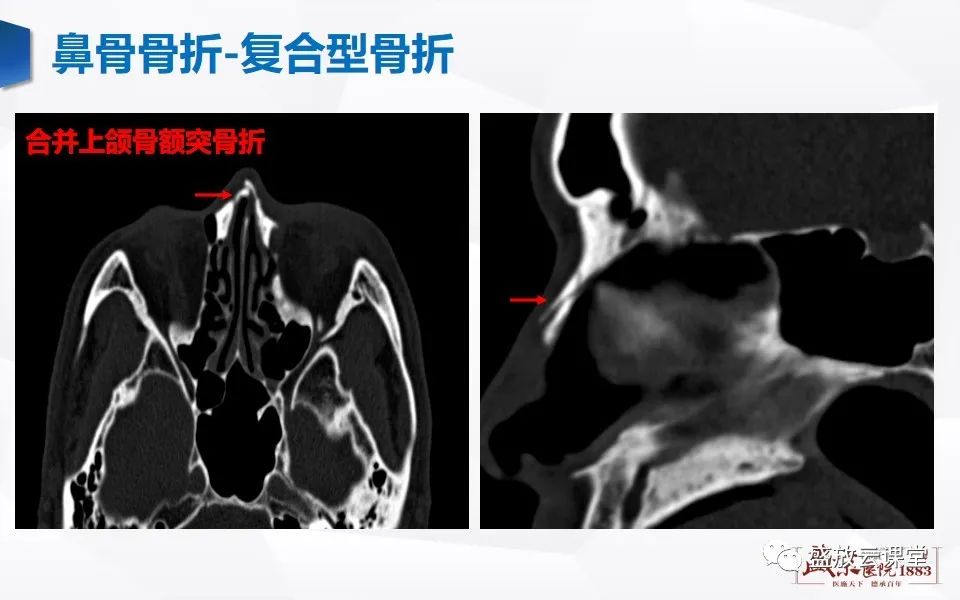 影像PPT - 【PPT】鼻骨正常CT解剖、变异与骨折-34