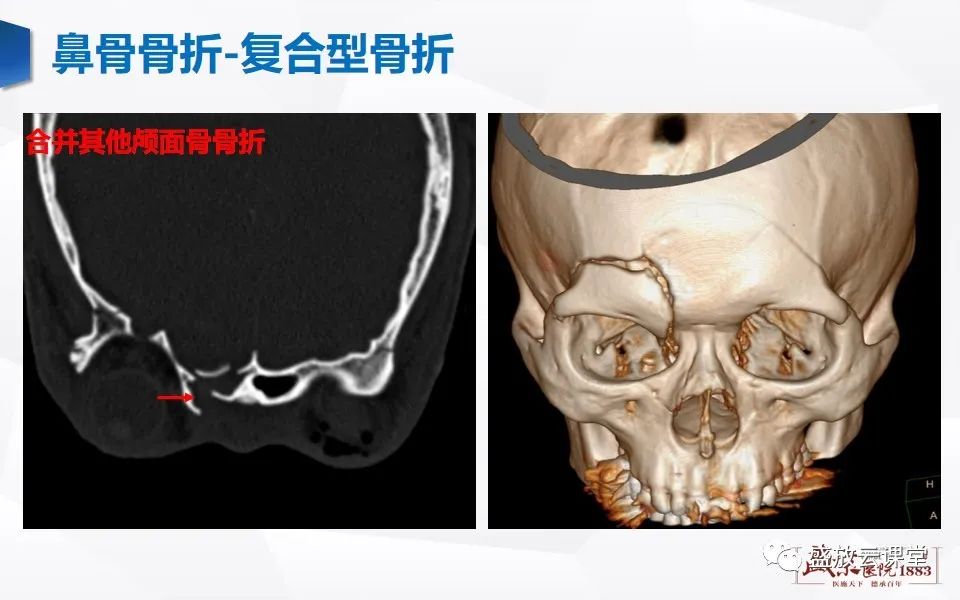 影像PPT - 【PPT】鼻骨正常CT解剖、变异与骨折-37