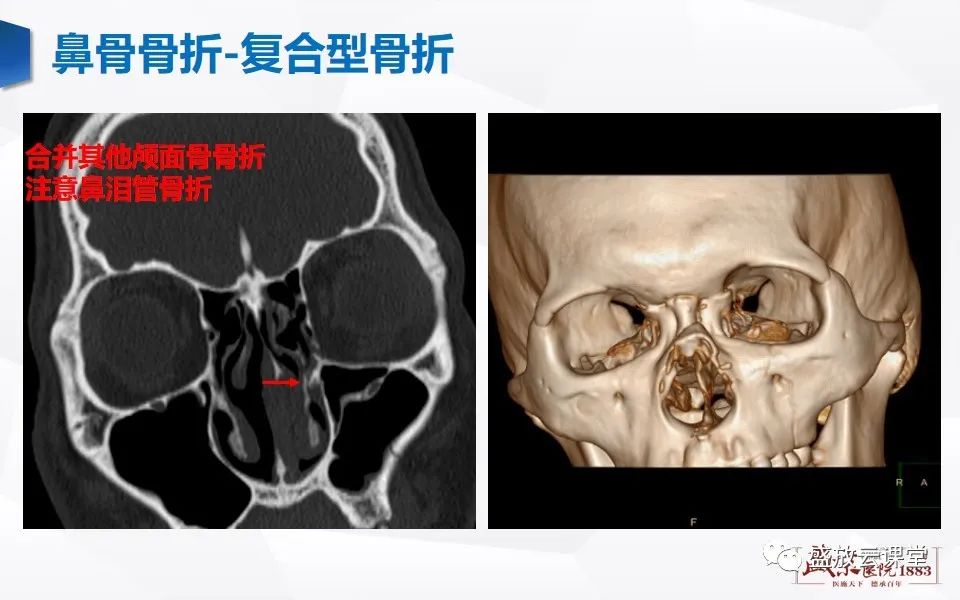 影像PPT - 【PPT】鼻骨正常CT解剖、变异与骨折-39