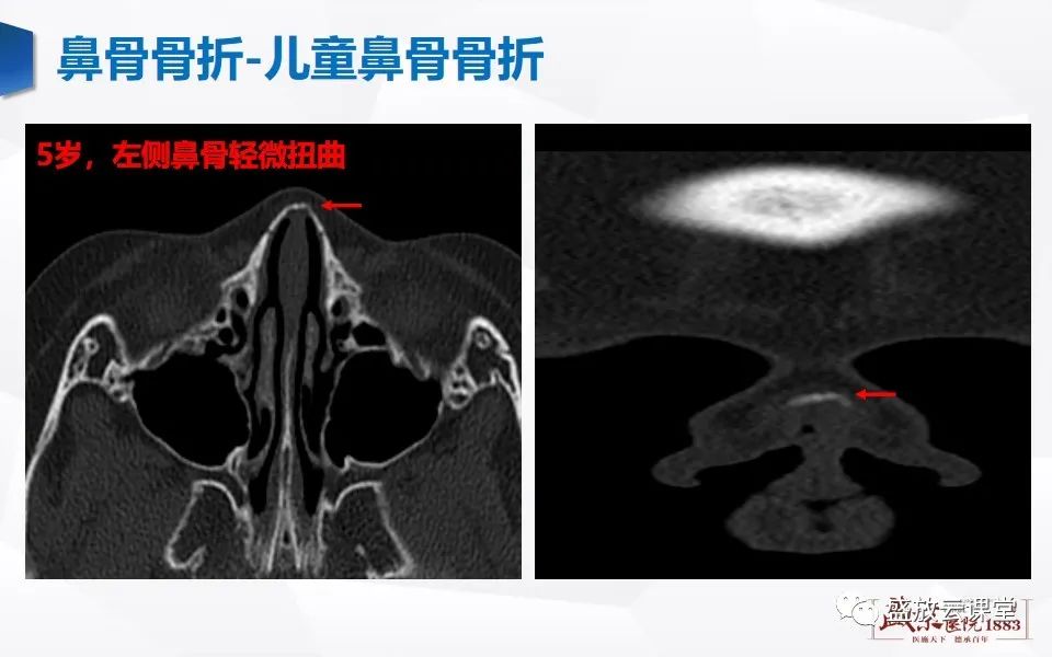 影像PPT - 【PPT】鼻骨正常CT解剖、变异与骨折-40