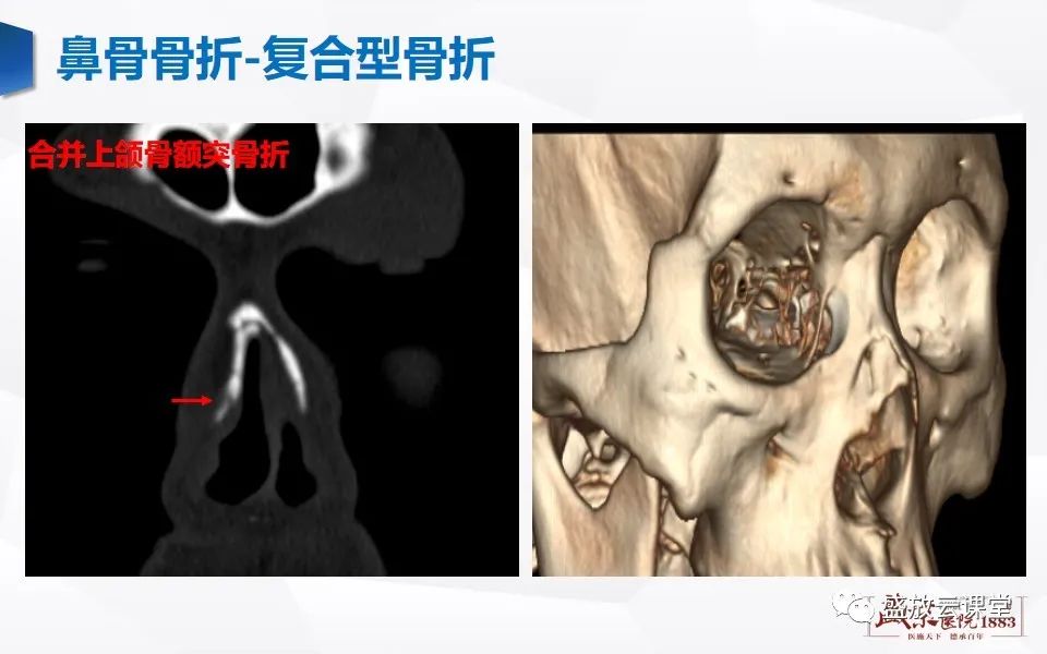 影像PPT - 【PPT】鼻骨正常CT解剖、变异与骨折-35