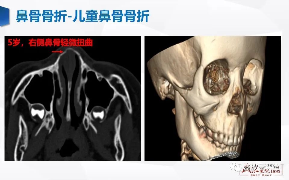 影像PPT - 【PPT】鼻骨正常CT解剖、变异与骨折-41