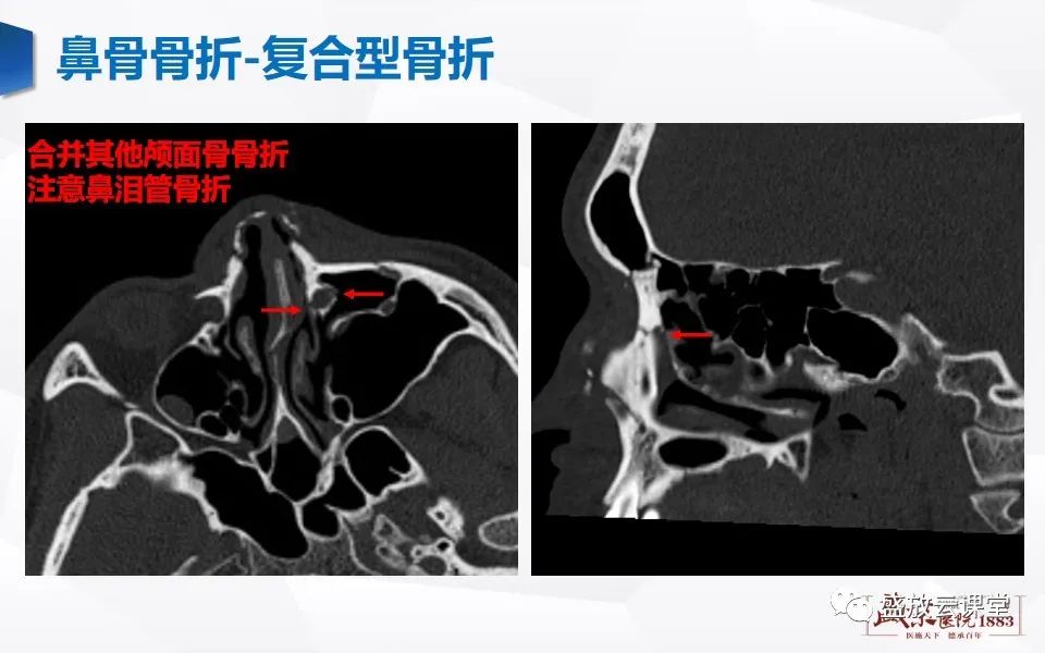 影像PPT - 【PPT】鼻骨正常CT解剖、变异与骨折-38