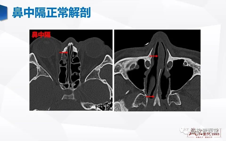 影像PPT - 【PPT】鼻骨正常CT解剖、变异与骨折-2