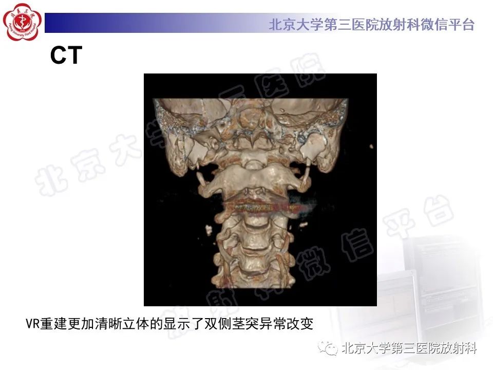 影像PPT - 【PPT】茎突综合征-5
