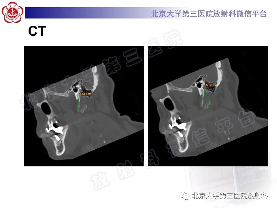 影像PPT - 【PPT】茎突综合征-4