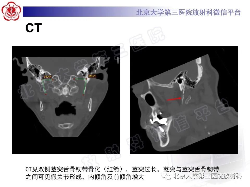 影像PPT - 【PPT】茎突综合征-3