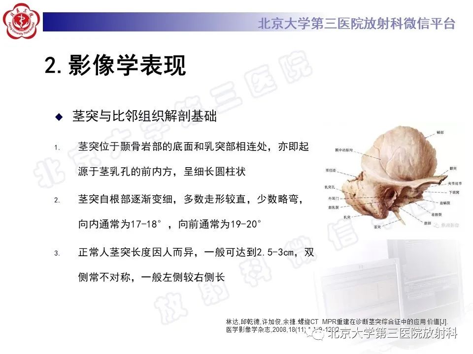 影像PPT - 【PPT】茎突综合征-11