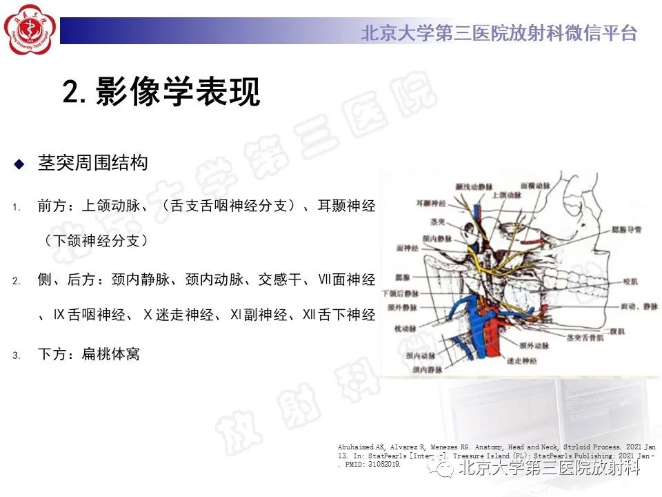 影像PPT - 【PPT】茎突综合征-14