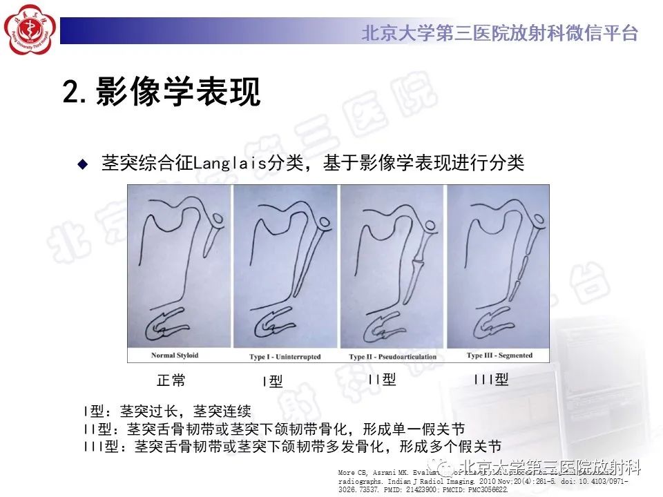 影像PPT - 【PPT】茎突综合征-18