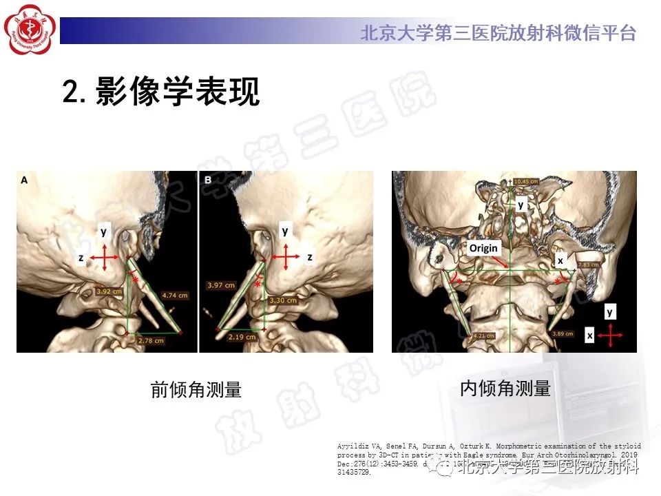 影像PPT - 【PPT】茎突综合征-17
