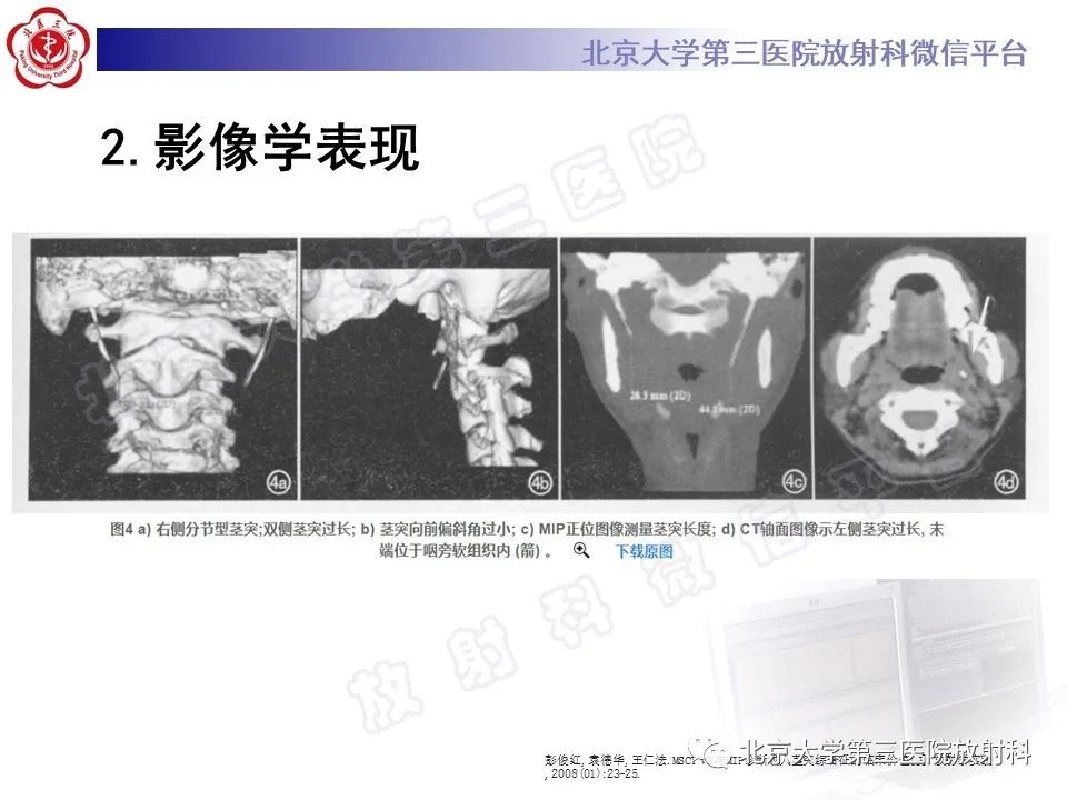 影像PPT - 【PPT】茎突综合征-19