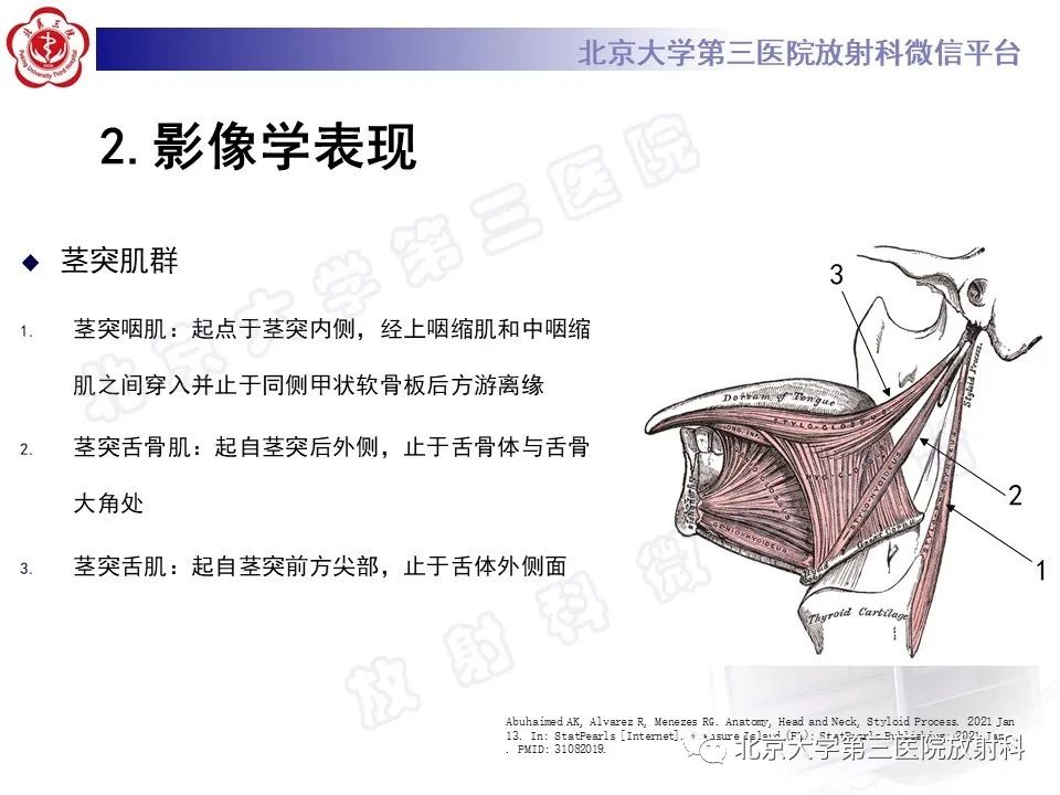 影像PPT - 【PPT】茎突综合征-12