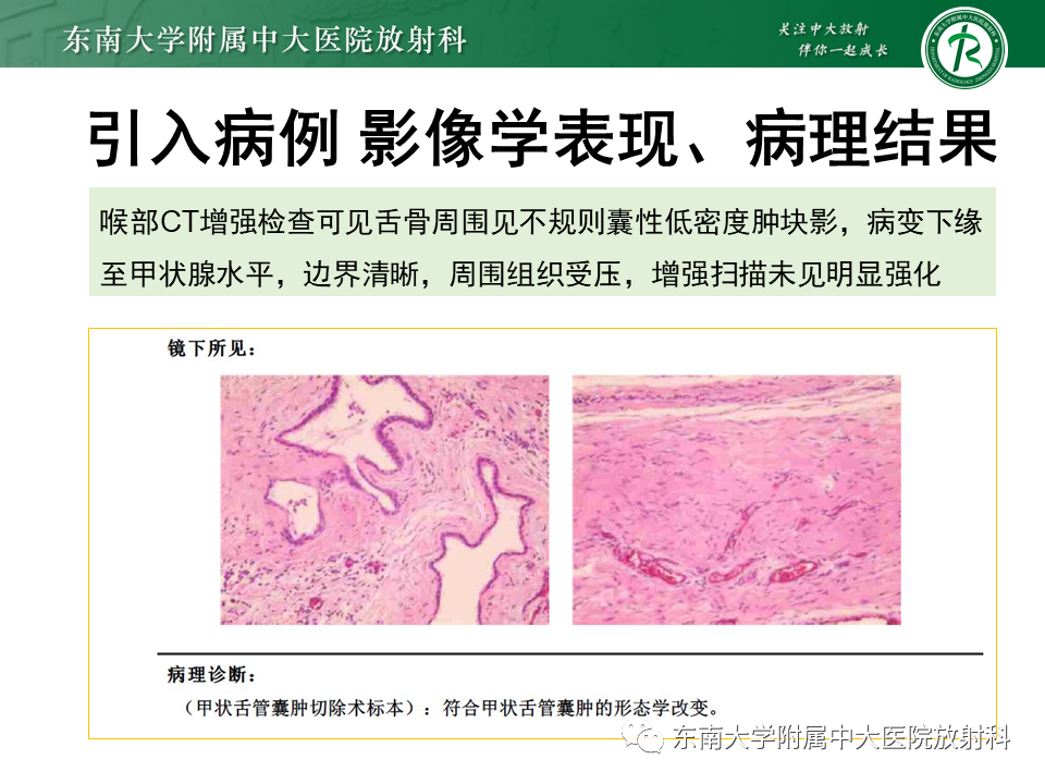 影像PPT - 【PPT】甲状舌管囊肿-2