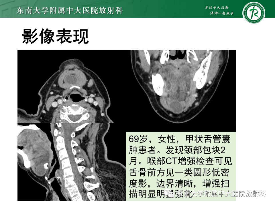 影像PPT - 【PPT】甲状舌管囊肿-11