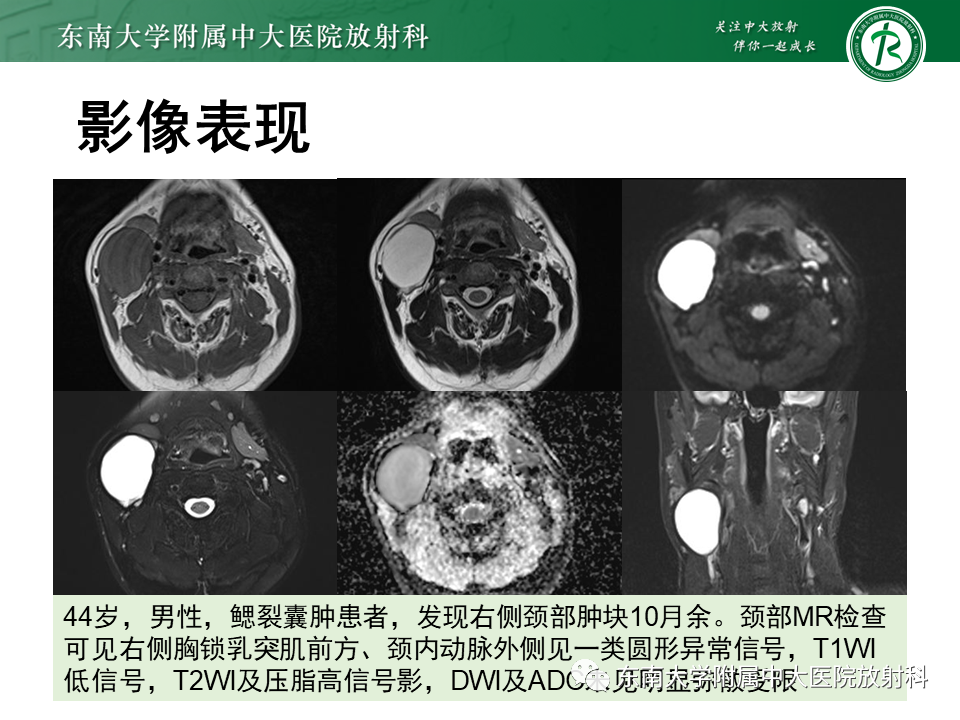 影像PPT - 【PPT】甲状舌管囊肿-17